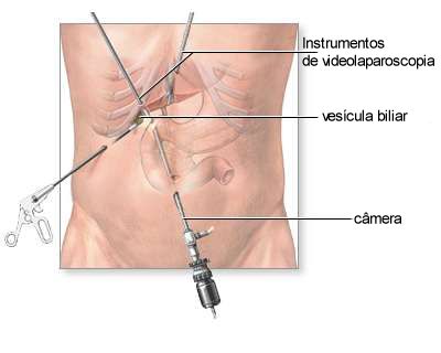 Pedra na vescula - Tratamento